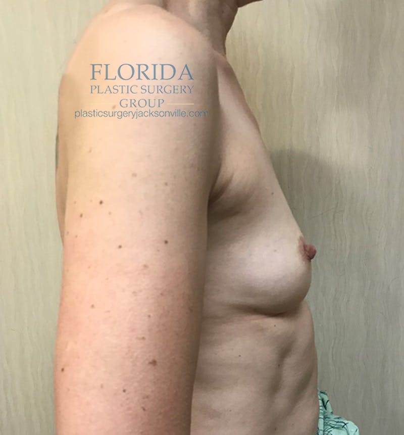 Silicone Breast Augmentation Before & After Gallery - Patient 154993552 - Image 3