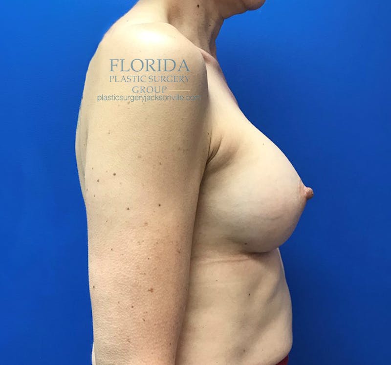 Silicone Breast Augmentation Before & After Gallery - Patient 154993552 - Image 4