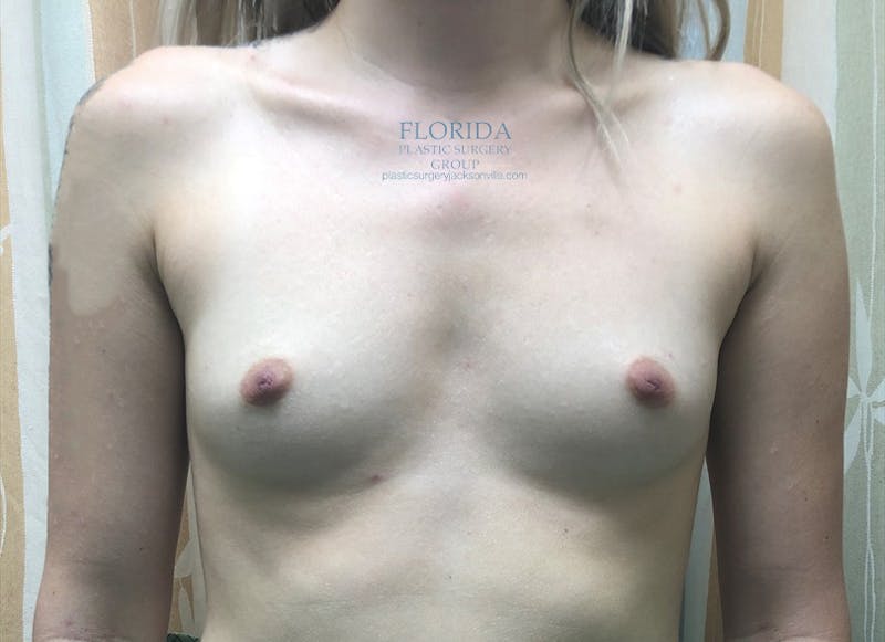 Silicone Breast Augmentation Before & After Gallery - Patient 154993556 - Image 1