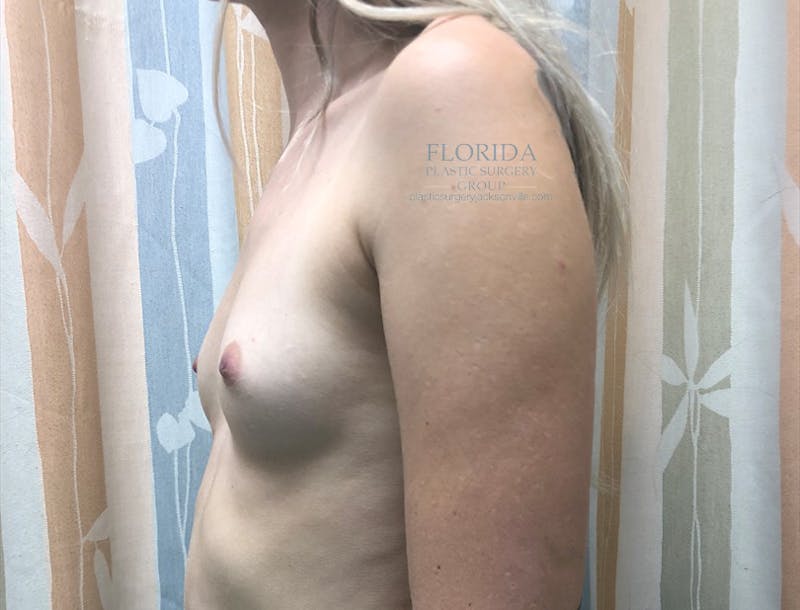 Silicone Breast Augmentation Before & After Gallery - Patient 154993556 - Image 3