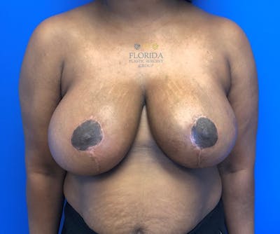 Breast Reduction Before & After Gallery - Patient 154993558 - Image 2