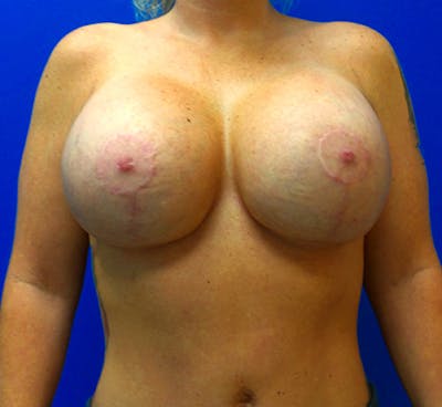 Revision Breast Surgery Before & After Gallery - Patient 154993559 - Image 2