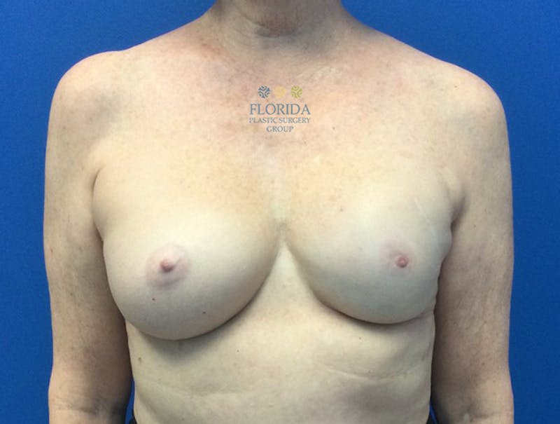 Tissue Expander Reconstruction Before & After Gallery - Patient 154993557 - Image 2