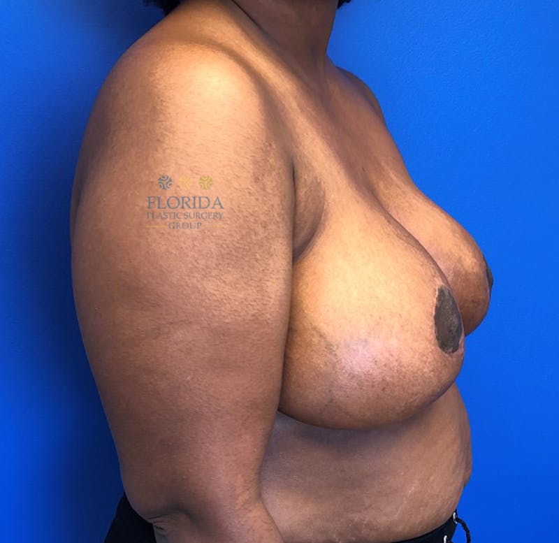 Breast Reduction Before & After Gallery - Patient 154993558 - Image 4
