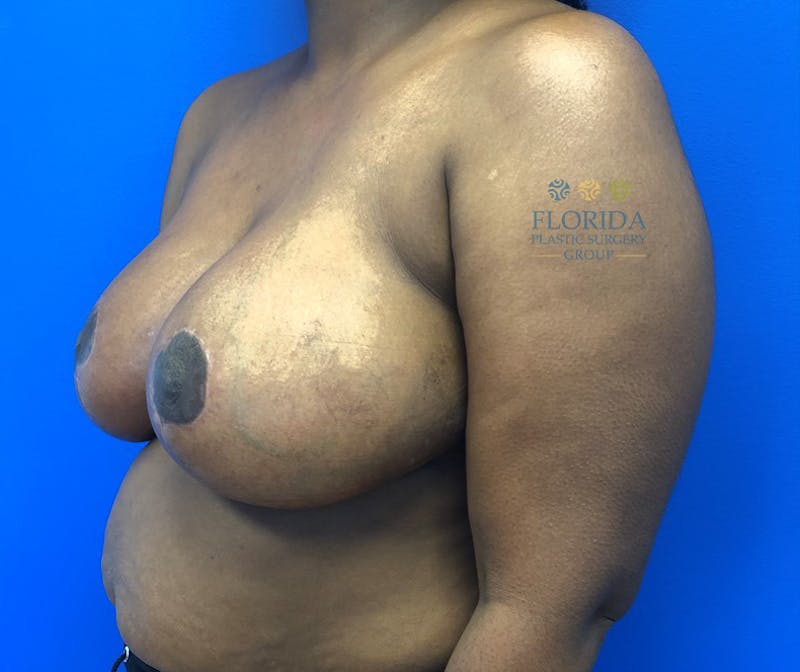 Breast Reduction Before & After Gallery - Patient 154993558 - Image 6
