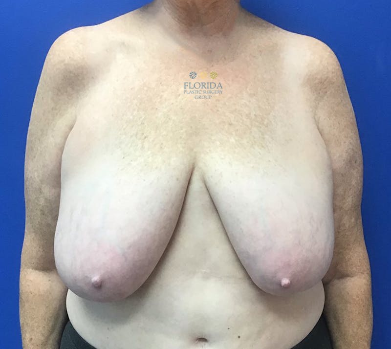 Breast Reduction Before & After Gallery - Patient 154993562 - Image 1