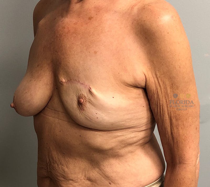 Tissue Expander Reconstruction Before & After Gallery - Patient 154993560 - Image 3