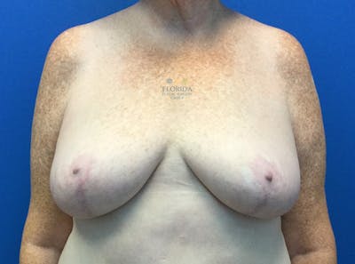 Breast Reduction Before & After Gallery - Patient 154993562 - Image 2