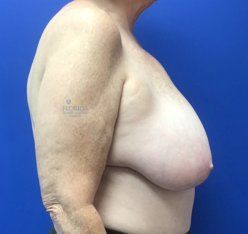 Breast Reduction Before & After Gallery - Patient 154993562 - Image 3
