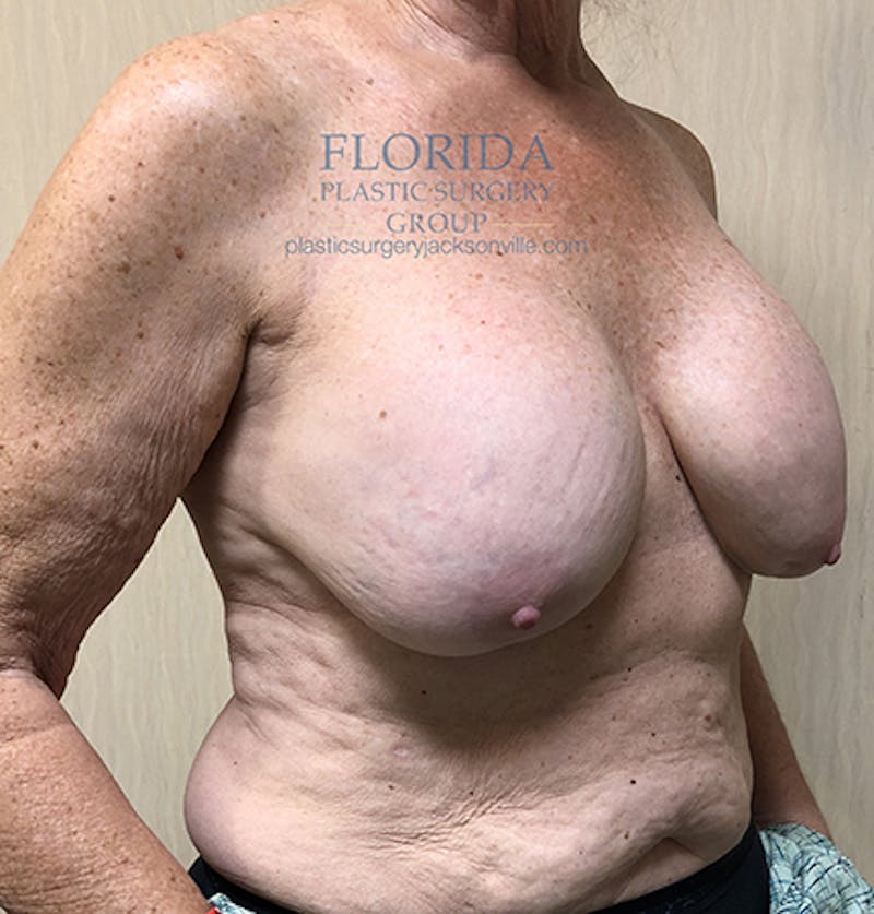 Revision Breast Surgery Before & After Gallery - Patient 154993563 - Image 3