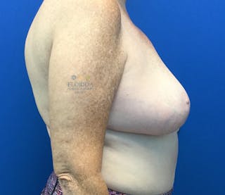 Breast Reduction Before & After Gallery - Patient 154993562 - Image 4