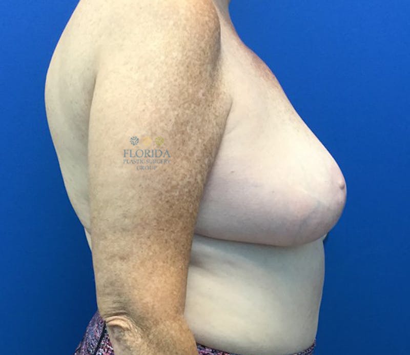 Breast Reduction Before & After Gallery - Patient 154993562 - Image 4