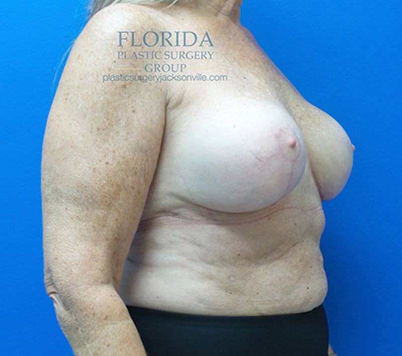 Revision Breast Surgery Before & After Gallery - Patient 154993563 - Image 4