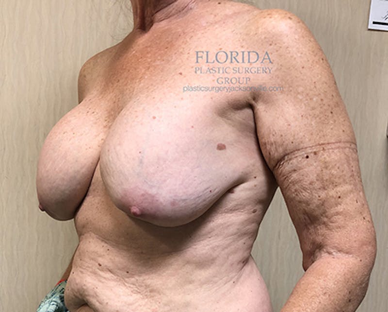 Revision Breast Surgery Before & After Gallery - Patient 154993563 - Image 5