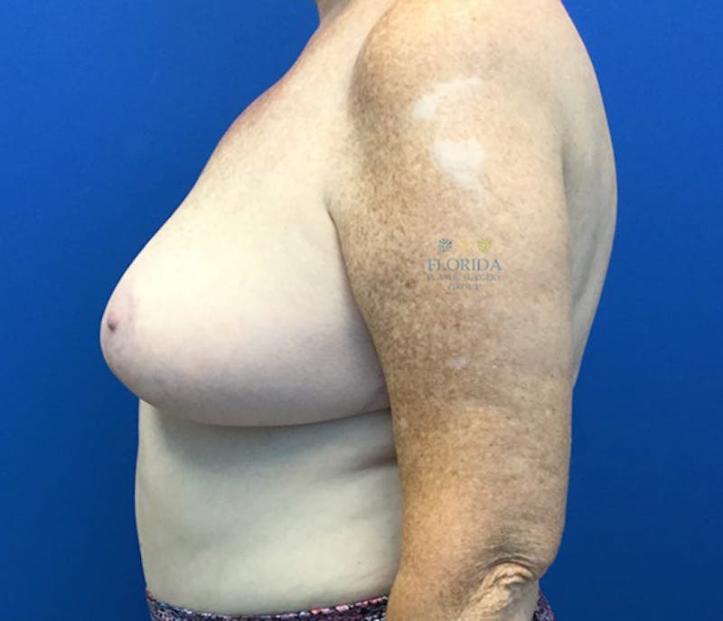 Breast Reduction Before & After Gallery - Patient 154993562 - Image 6