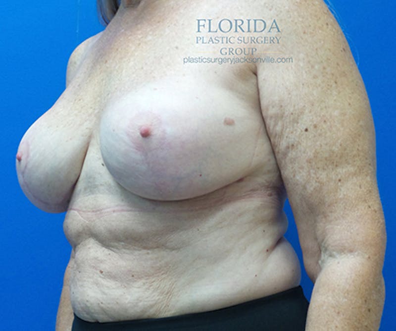 Revision Breast Surgery Before & After Gallery - Patient 154993563 - Image 6