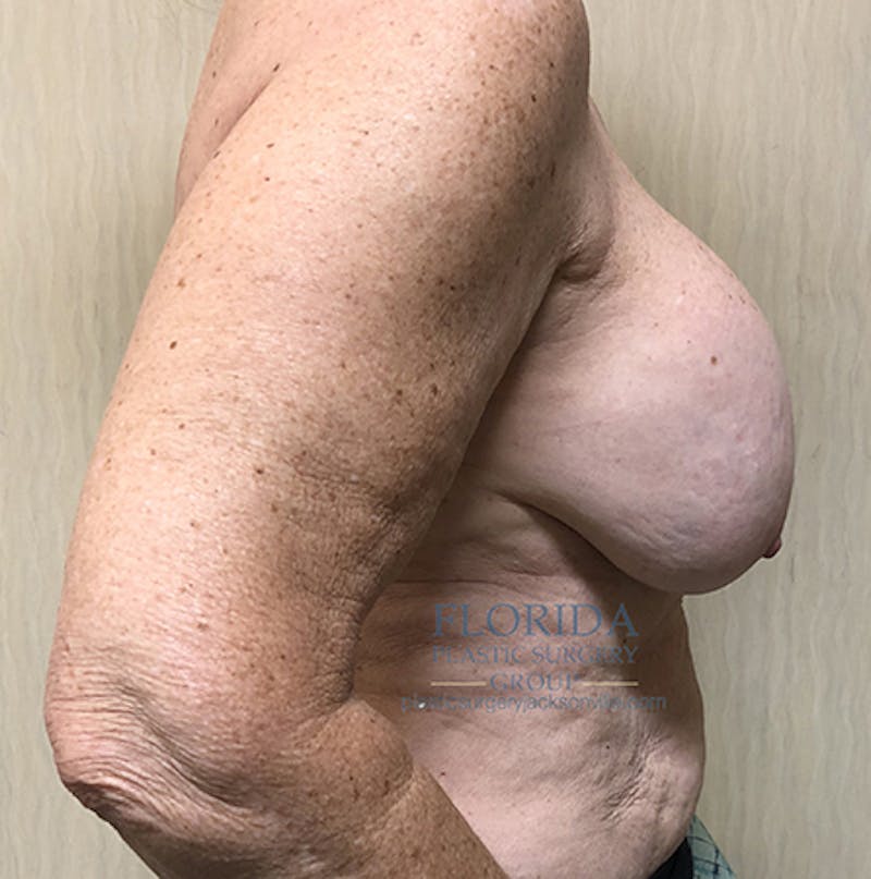 Revision Breast Surgery Before & After Gallery - Patient 154993563 - Image 7