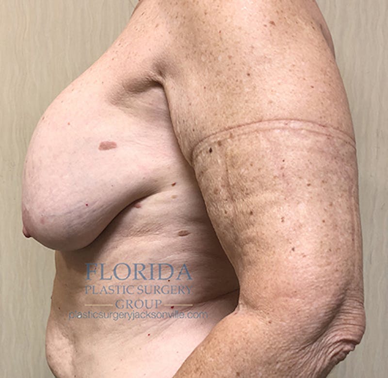 Revision Breast Surgery Before & After Gallery - Patient 154993563 - Image 9