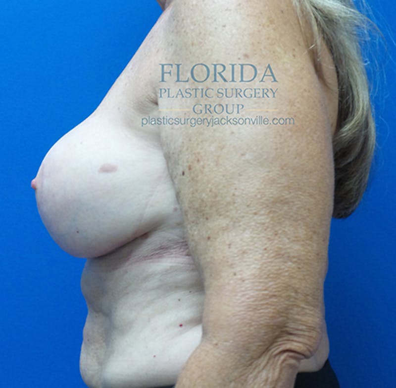 Revision Breast Surgery Before & After Gallery - Patient 154993563 - Image 10