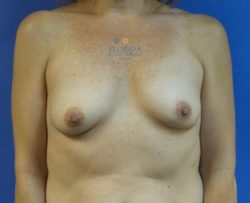 Silicone Breast Augmentation Before & After Gallery - Patient 154993568 - Image 1