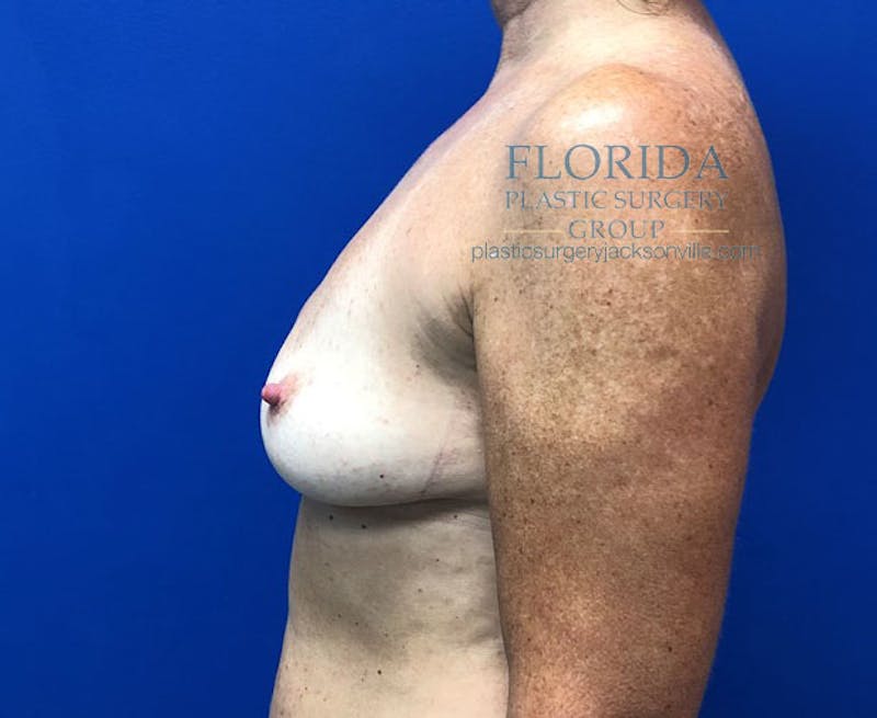 Revision Breast Surgery Before & After Gallery - Patient 154993570 - Image 5