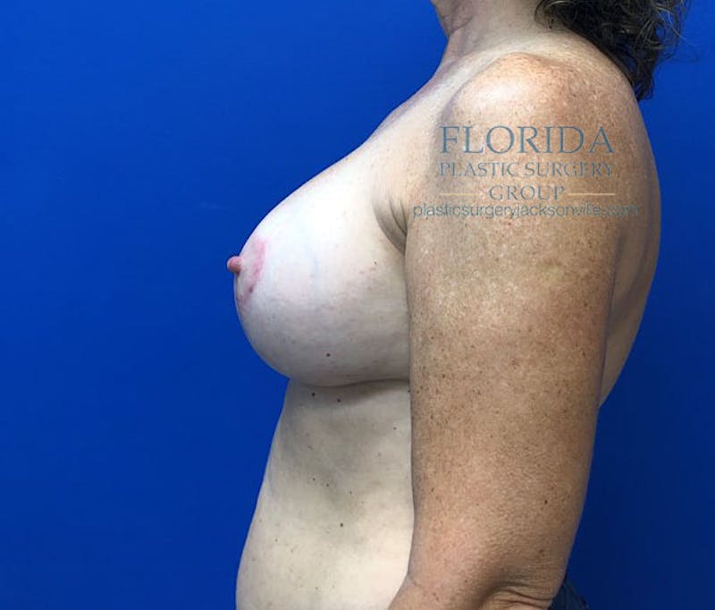 Revision Breast Surgery Before & After Gallery - Patient 154993570 - Image 6