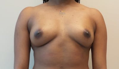 Silicone Breast Augmentation Before & After Gallery - Patient 154993573 - Image 1