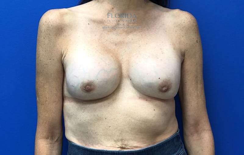 Revision Breast Surgery Before & After Gallery - Patient 154993575 - Image 1
