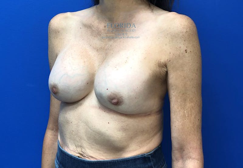 Revision Breast Surgery Before & After Gallery - Patient 154993575 - Image 3