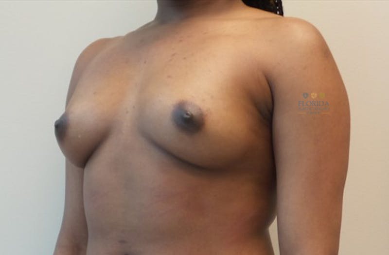 Silicone Breast Augmentation Before & After Gallery - Patient 154993573 - Image 5