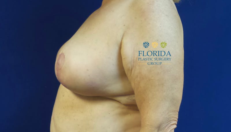 Breast Reduction Before & After Gallery - Patient 154993572 - Image 4