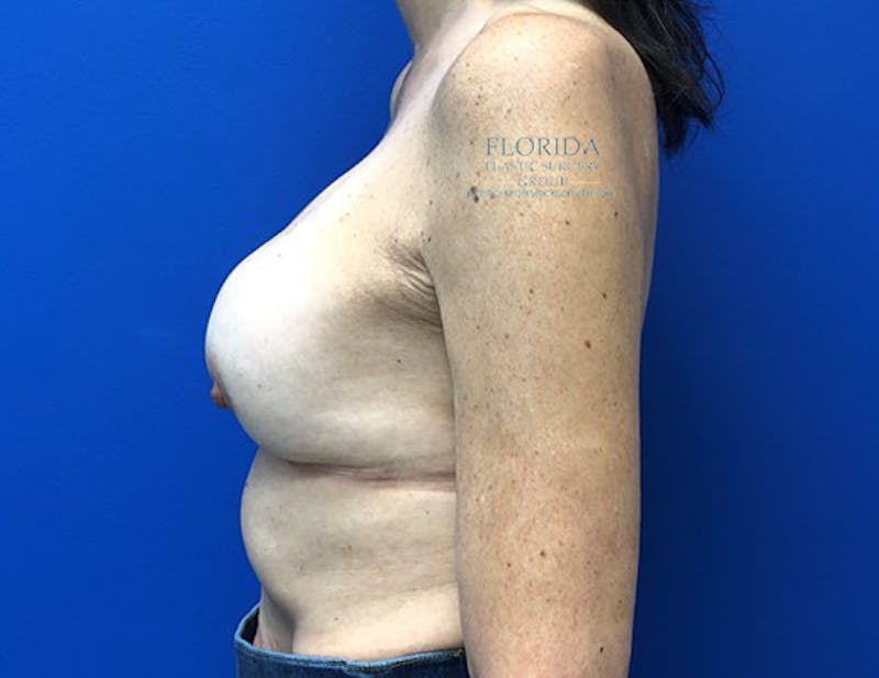 Revision Breast Surgery Before & After Gallery - Patient 154993575 - Image 5