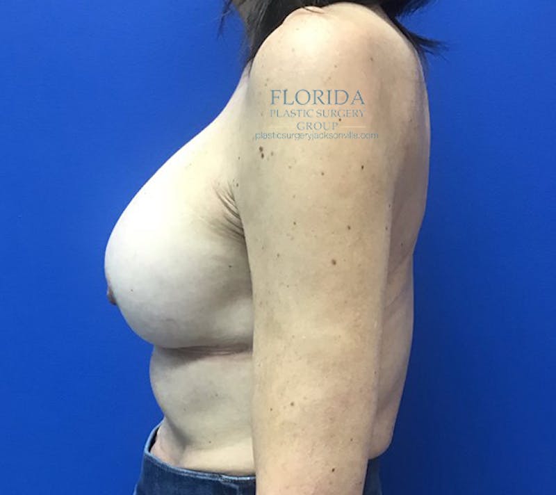 Revision Breast Surgery Before & After Gallery - Patient 154993575 - Image 6