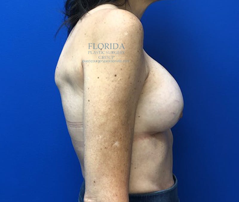 Revision Breast Surgery Before & After Gallery - Patient 154993575 - Image 9