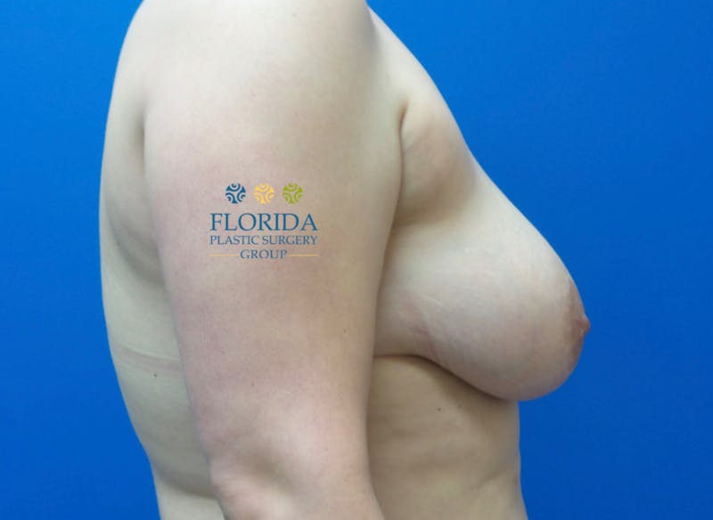 Breast Reduction Before & After Gallery - Patient 154993576 - Image 3
