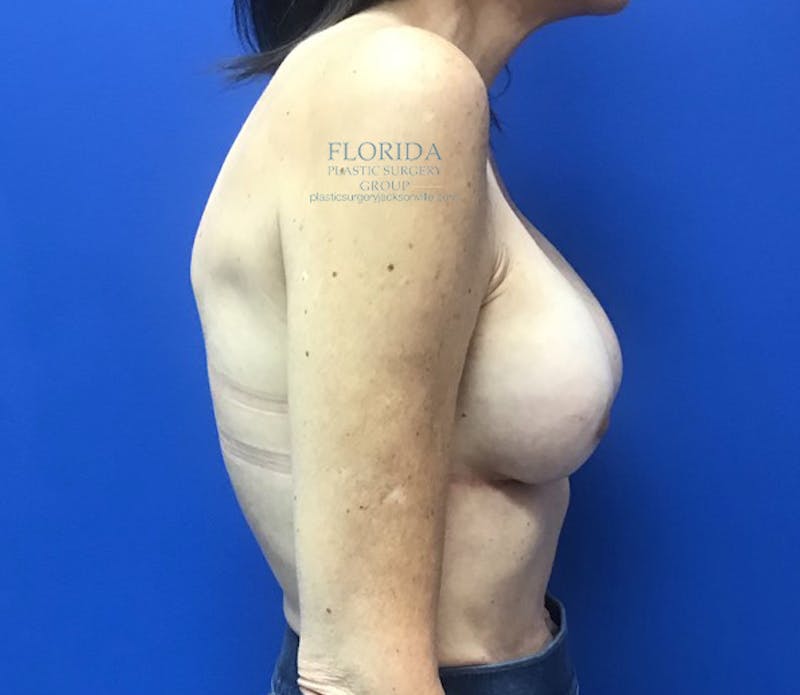 Revision Breast Surgery Before & After Gallery - Patient 154993575 - Image 10