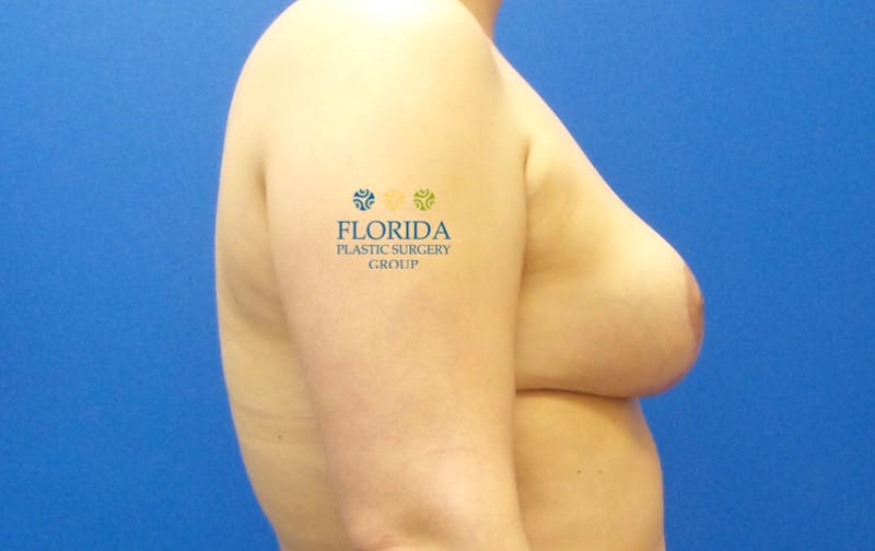 Breast Reduction Before & After Gallery - Patient 154993576 - Image 4