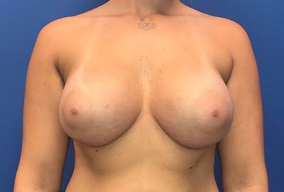 Silicone Breast Augmentation Before & After Gallery - Patient 154993578 - Image 2