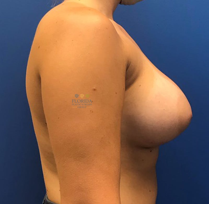 Silicone Breast Augmentation Before & After Gallery - Patient 154993578 - Image 4