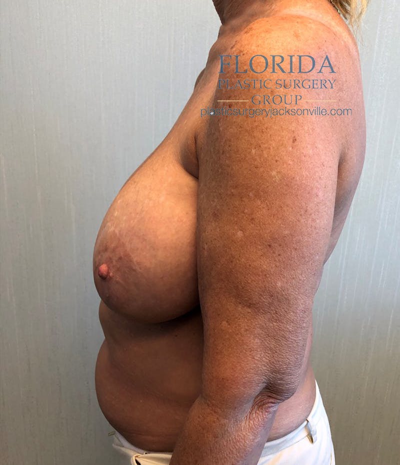 Revision Breast Surgery Before & After Gallery - Patient 154993579 - Image 3