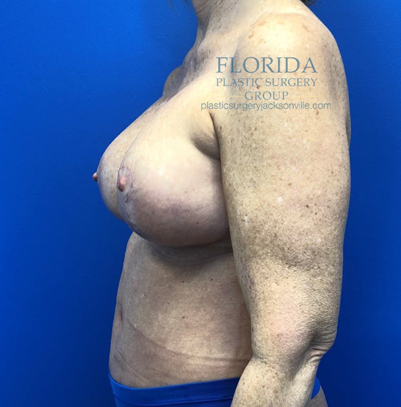 Revision Breast Surgery Before & After Gallery - Patient 154993579 - Image 4