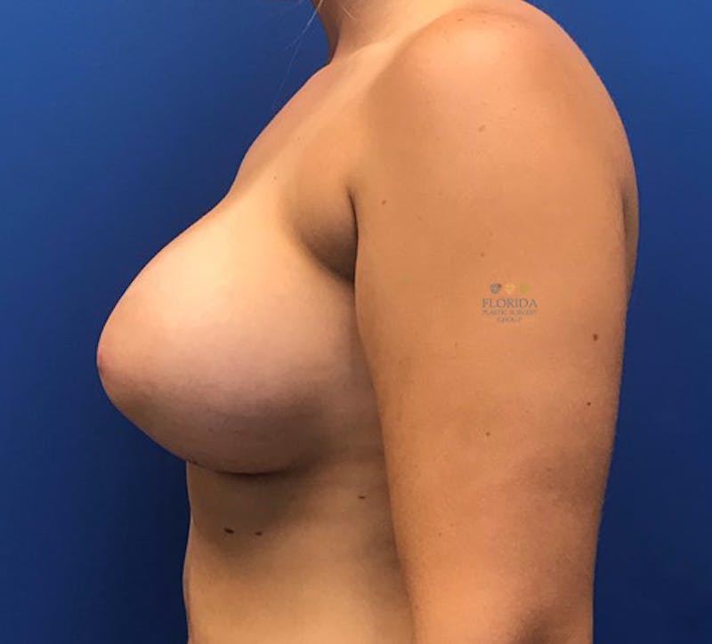 Silicone Breast Augmentation Before & After Gallery - Patient 154993578 - Image 6