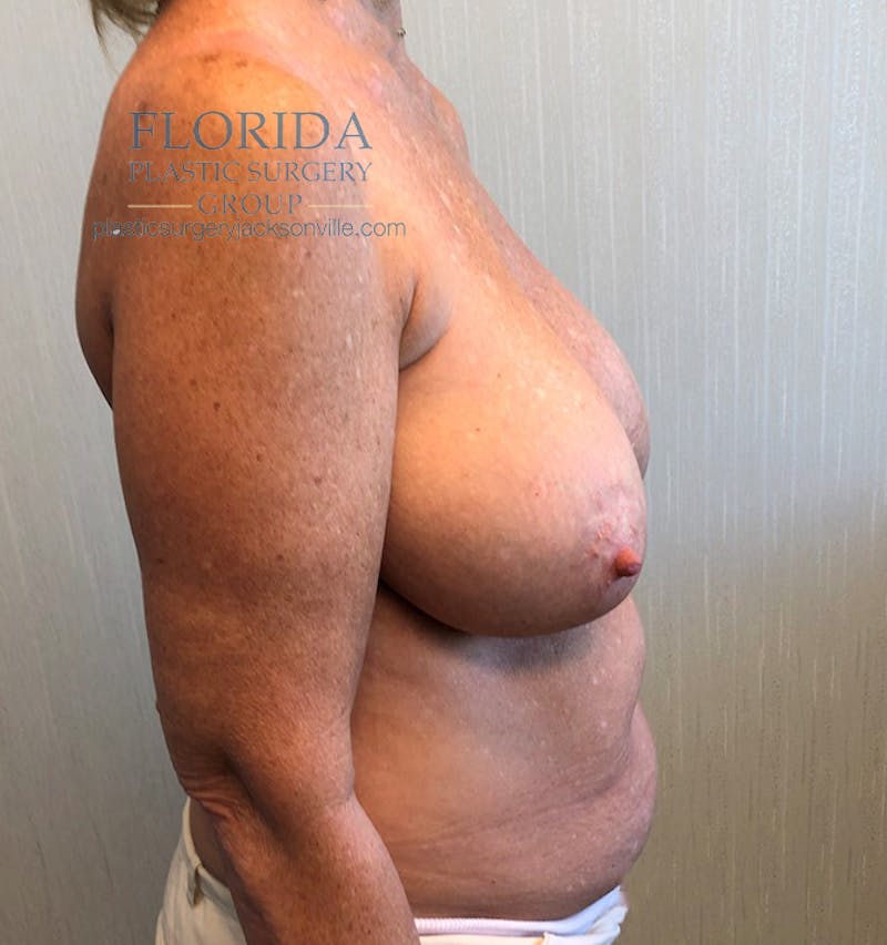 Revision Breast Surgery Before & After Gallery - Patient 154993579 - Image 5