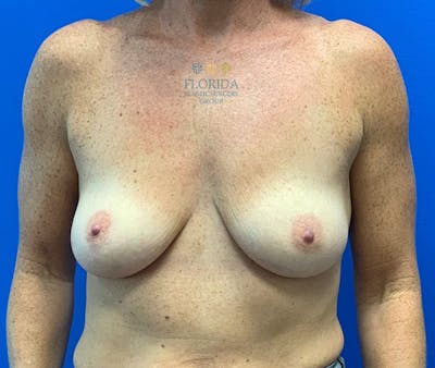 Silicone Breast Augmentation Before & After Gallery - Patient 154993582 - Image 1