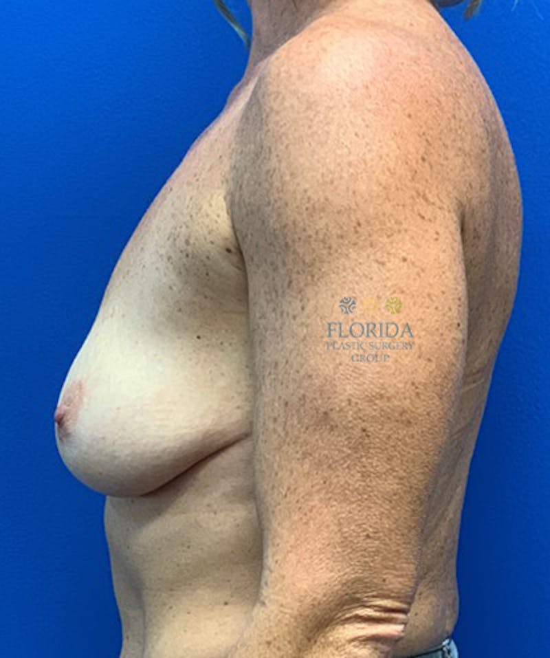 Silicone Breast Augmentation Before & After Gallery - Patient 154993582 - Image 3