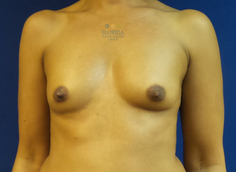 Silicone Breast Augmentation Before & After Gallery - Patient 154993585 - Image 1