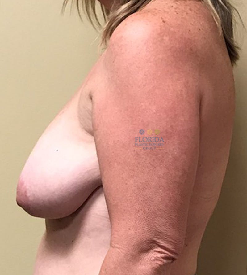 Breast Reduction Before & After Gallery - Patient 154993584 - Image 3
