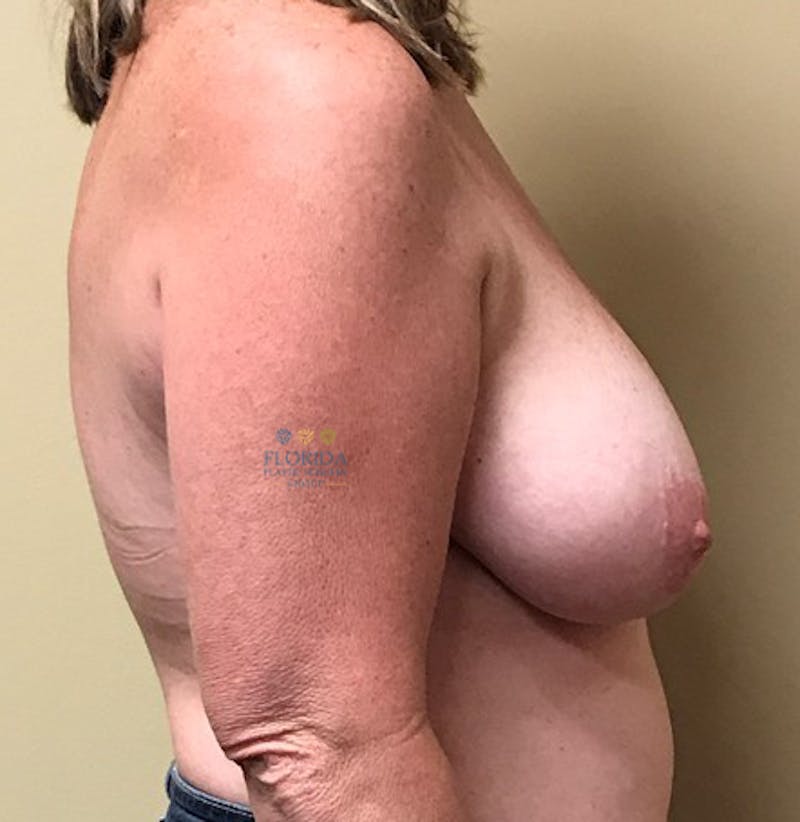 Breast Reduction Before & After Gallery - Patient 154993584 - Image 5