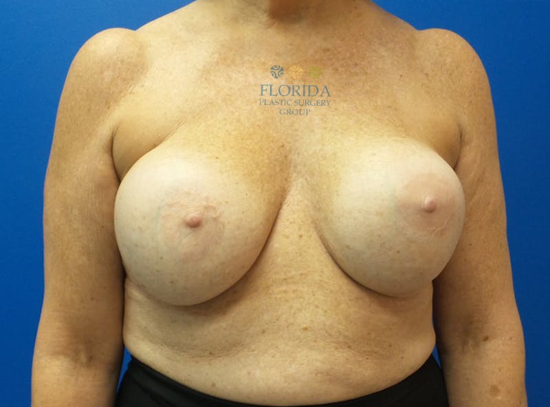 Revision Breast Surgery Before & After Gallery - Patient 154993587 - Image 1