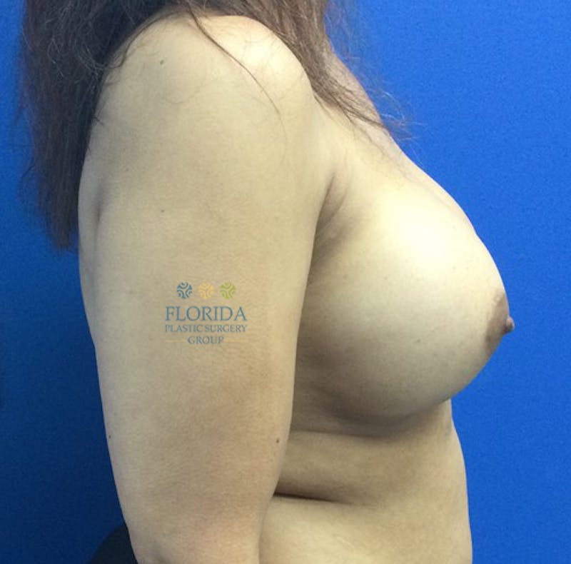 Silicone Breast Augmentation Before & After Gallery - Patient 154993585 - Image 6